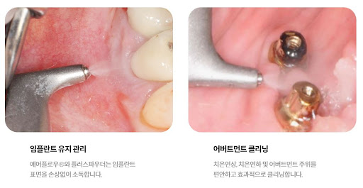 불당본점 서울비디치과의원에서 제공하는 천안 임플란트와 치아교정의 최고 품질과 결과