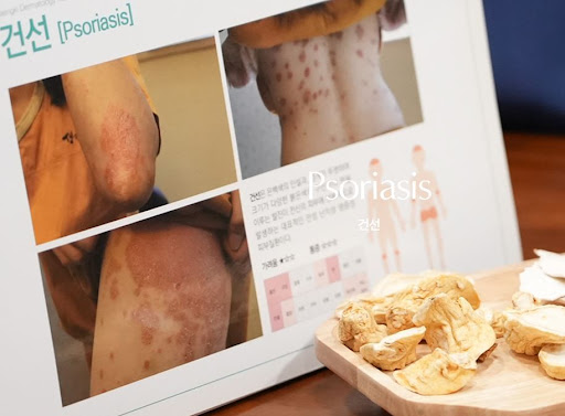 생기한의원이 안내하는 건선 진료 전 알아두면 좋은 정보